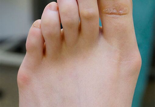 Pé de valgus
