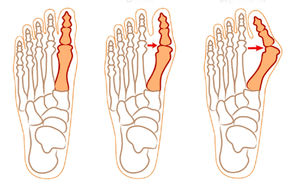 Hallux Valgus Deformidade