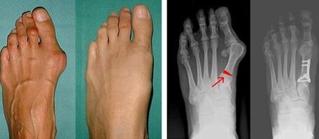 síntomas de hallux valgus