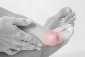 Hallux valgus como elixir os zapatos