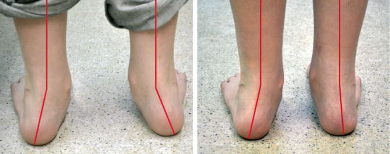 Patas de valgus