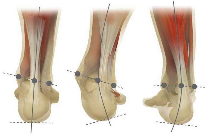Tipos de valgus