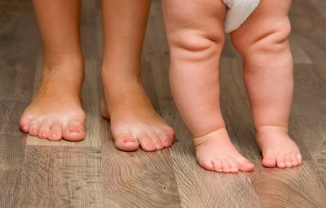 Deformación do pé de valgus nos nenos