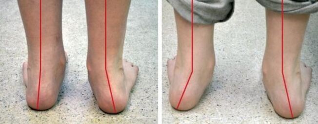 Pé de valgus